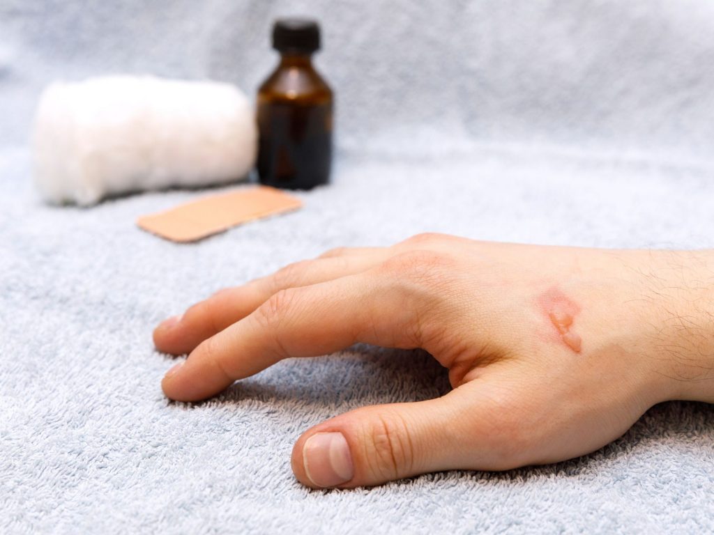 use essential oils to treat scars