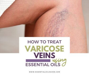 best essential oils for varicose veins