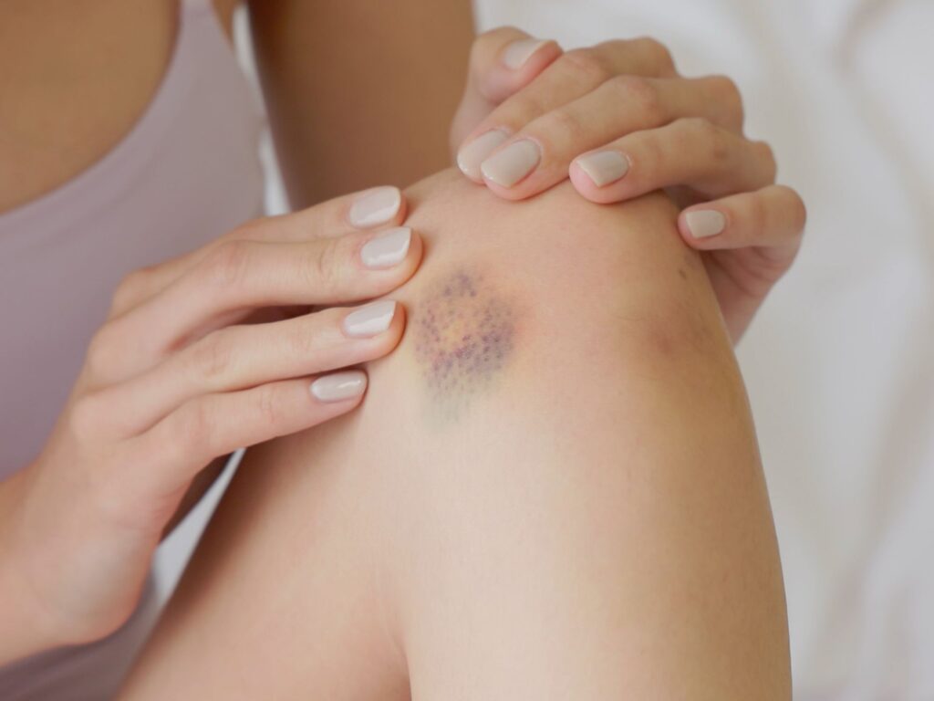 use essential oils on your bruises for a natural home remedy