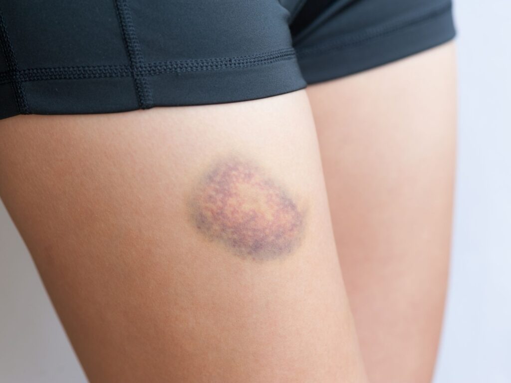 bruise on thigh