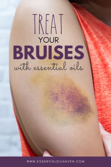 treat your bruises with esssential oil