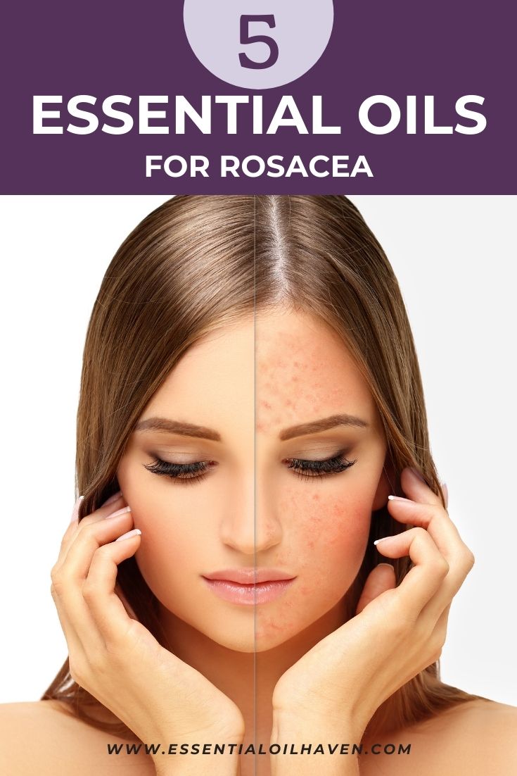 5 Best Essential Oils For Rosacea (PLUS Recipes That Use Them)