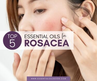 natural home remedy for rosacea